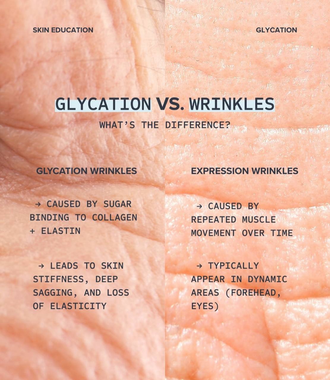Glycation vs Expression Wrinkles — perbezaan kedut